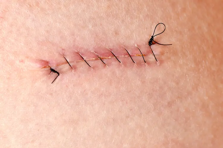 Dissolvable Stitches Explained: Healing Time, How They Work, Benefits, Risks & Aftercare dissolvable stitches